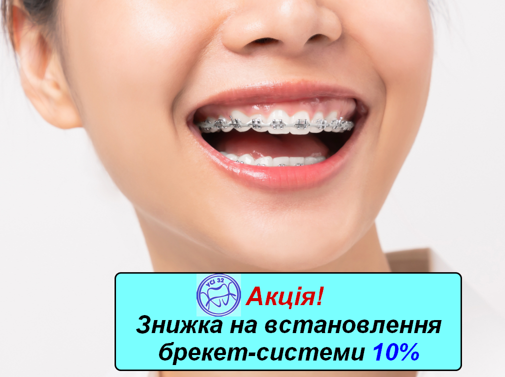 Весняна акція на втановлення брекет-системи